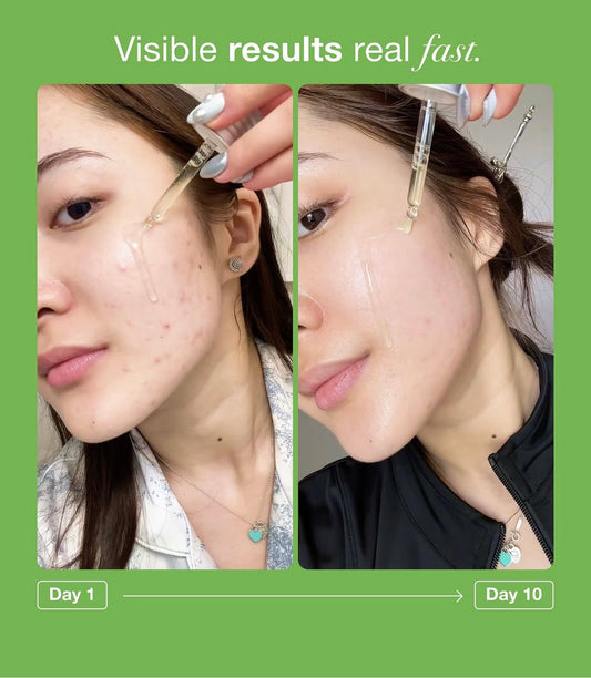 Anua 10+ azelaic acid 10+ hyaluron-سيروم أنوا أزيليك 10% + هيالورونيك